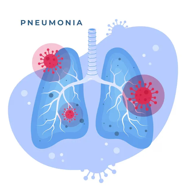 pneumonia - Cadence Collaborative
